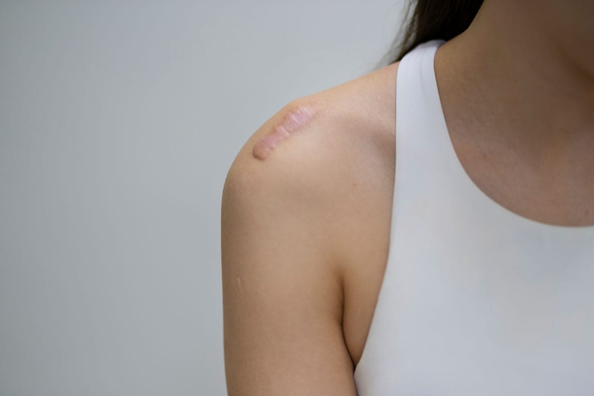 woman with a keloid scar in Murrieta, CA